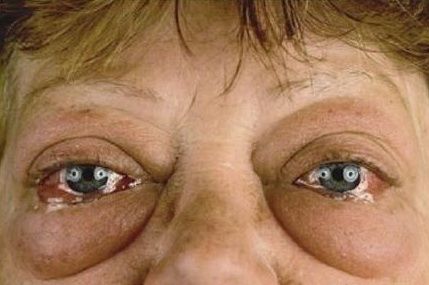 不动刀不吃药,黄瓜片泡一泡"液体"贴眼,不反弹轻松祛眼袋