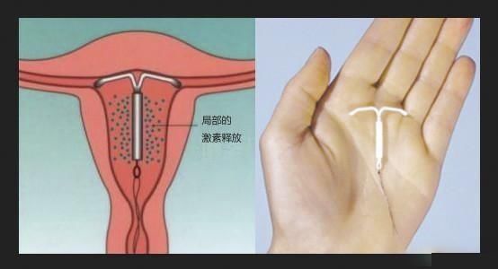 生完孩子到底要不要上环?是否会引起妇科病?