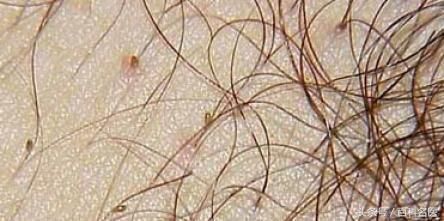 头上长虱子,男子用敌敌畏洗头,中毒住院!虱子应