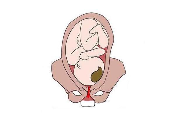 生孩子的时候,孕妈肚子里都发生了什么?大多妈妈都不知道