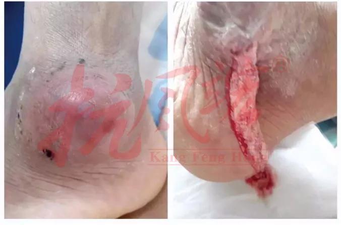 降尿酸药能溶解尿酸盐结晶、痛风石吗?(图7) 降尿酸药能溶解尿酸盐结晶、痛风石吗?(图7)