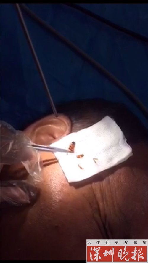蟑螂半夜爬入耳朵 医生竟取出活体蟑螂