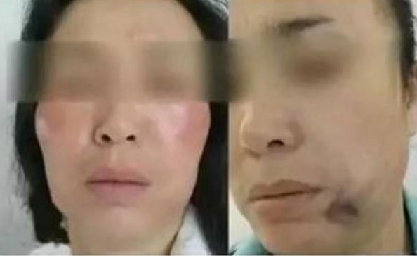 线雕在韩国被禁止,线雕为什么被禁止?蛋白线提