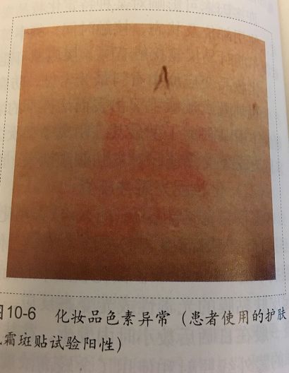 最新一批烂脸激素护肤品曝光,杨紫舒淇都用过