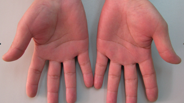 熬夜的你是不是手掌发红 当心增加心梗脑梗风险