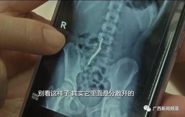 后果很严重!9岁女孩肠道破洞,因为误吞了这个