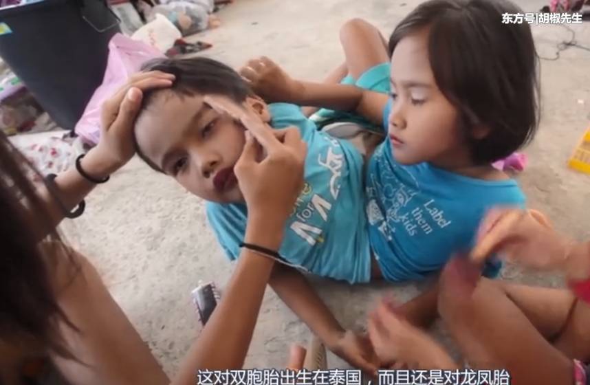 大家都知道拥有一对双胞胎是一个家庭的福气,一下生出一对双胞胎是也并不常见的,但是并不是所有的双胞胎都是那么幸运的,就像今天讲的这对双胞胎。这对双胞胎出生于泰国,而且还是一对龙凤胎。这就更加难得了,但是这对龙凤胎非常不幸。因为他们是连体人,腰部以下全都是连在一起的。但是两个孩子又有着两套不同的生殖系统。这是个非常尴尬的问题,虽然在现在他们还不觉得有什么尴尬,但是随着他们渐渐长大,麻烦的问题就会越来越多。小到上厕所应该进男厕所还是女厕所,大到以后的结婚生子,这些都是摆在他们人生路上的大问题。