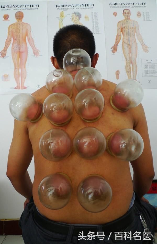 亚运会游泳选手满背火罐印记!中医秘方很流行