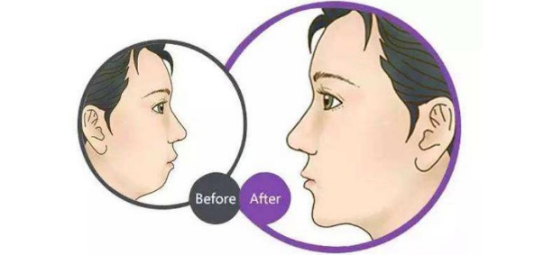 牙套和整形哪个改善下巴后缩自然可靠?