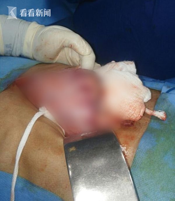 男子吞下639根钉子 医生用磁铁吸出来