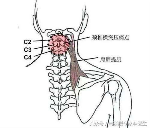 李医生:颈椎病头晕怎么办?这3个答案可以帮助