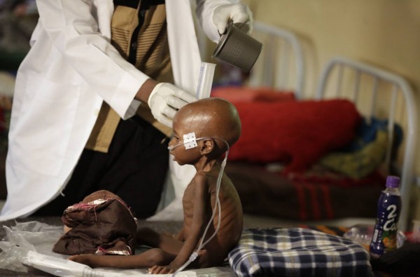 尼日利亚难民饥荒 一周内20个孩子被活活饿死