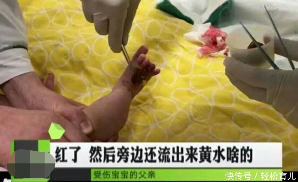 四个月的宝宝哭闹不止,医生扯下宝宝的袜子后,宝妈被吓得腿发抖