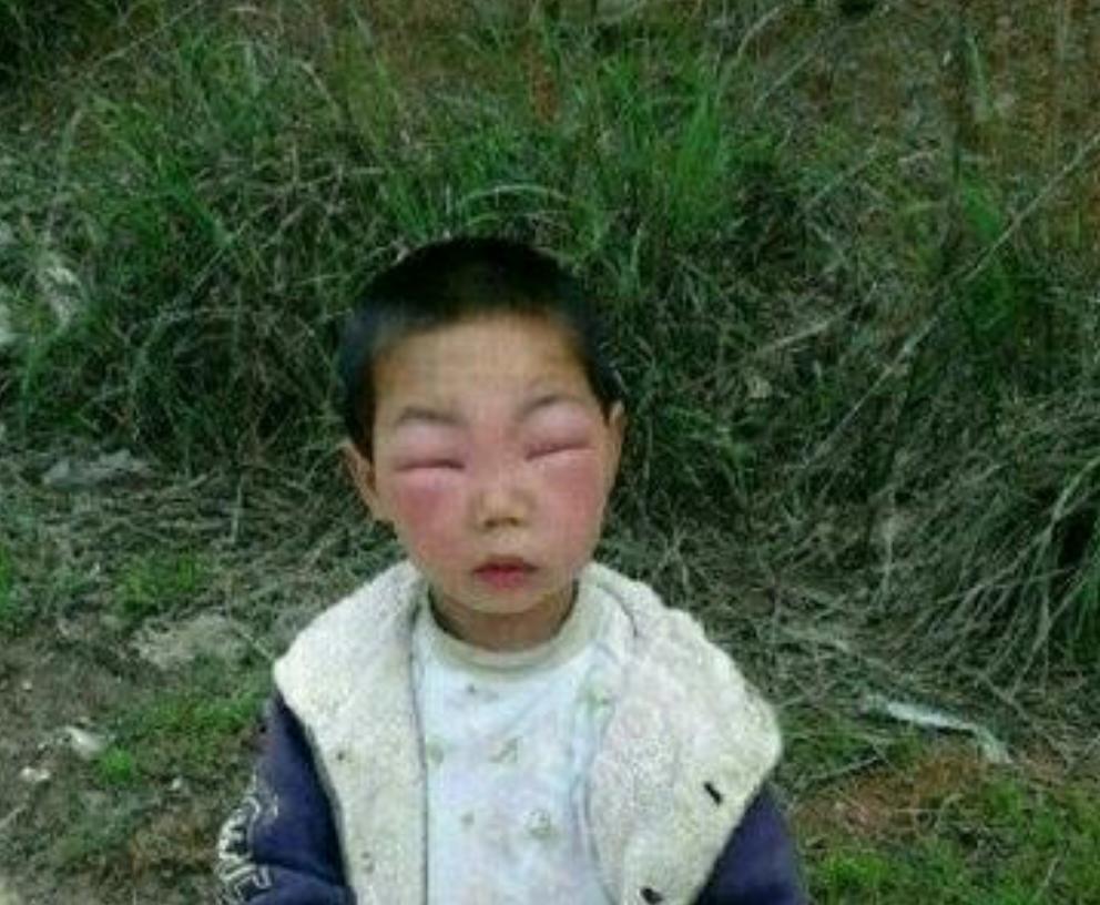 熊娃捅马蜂窝被蛰!虫咬过敏如何处理?