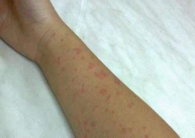 吃芒果过敏是一种什么样的体验?如果有人卖抗