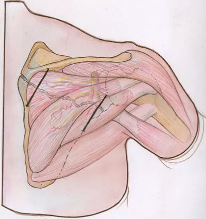 肩胛骨骨折的三种手术入路方式 | 骨科基础