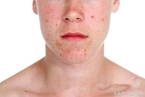 长了痤疮该怎么办?告诉你正确的处理方法和家