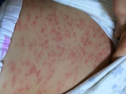 为什么宝宝发烧去医院医生总是让先查血,你知