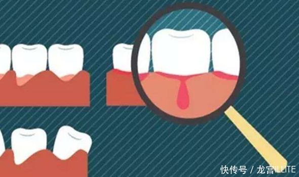 牙龈出血选用什么牙膏好?-北京时间