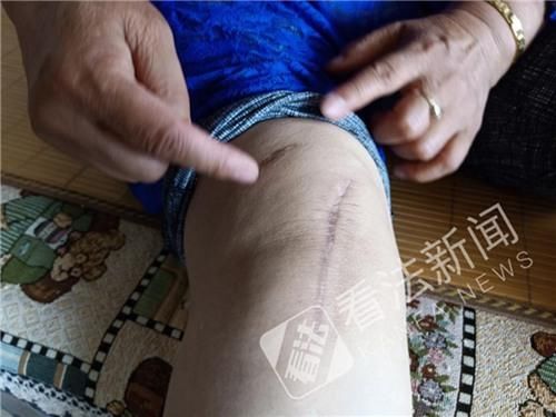 老人家门口遭蒙面人打断腿追踪:小区物业负责人被批捕