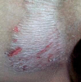 大腿内侧瘙痒红肿怎么办?巧妙护理快速迎来健