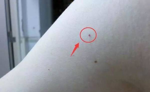身上长出这种“小红点”要重视 肝功能正常也可能存在肝损伤 身上长出这种“小红点”要重视 肝功能正常也可能存在肝损伤