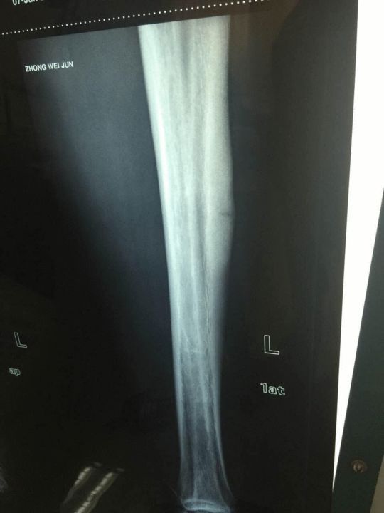 重炮疲劳性骨折伤停3月 男排急调3将征战世联赛