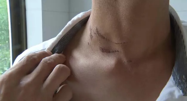 南通一男子家中遇人讨水 被瞬间掐住脖子拼死相搏 南通一男子家中遇人讨水 被瞬间掐住脖子拼死相搏