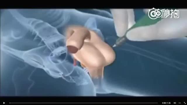 泰国人妖变性手术全过程，3D动画视频出炉！