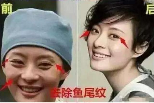 孙俪晒出邓超整容前后对比照?脸部的变化太明