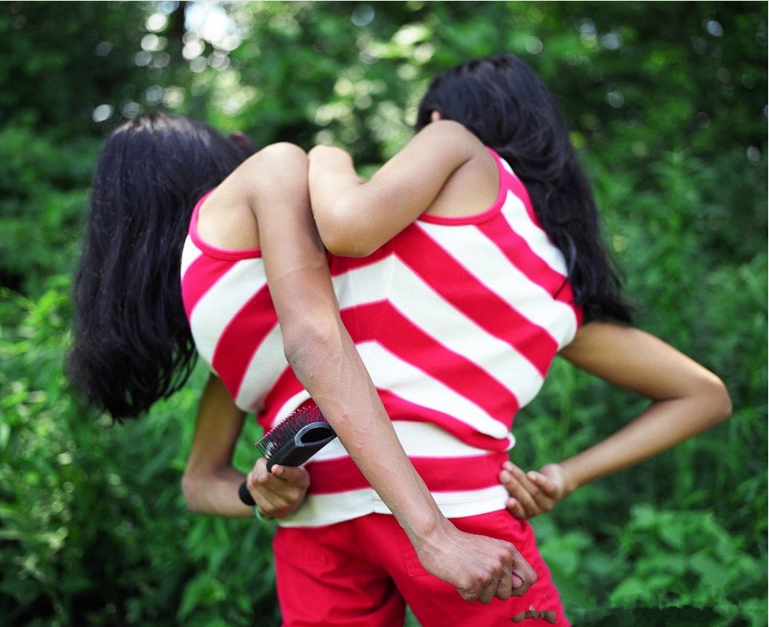 她们被认为活不过三天,如今已上大学,走路时每人控制一只腿