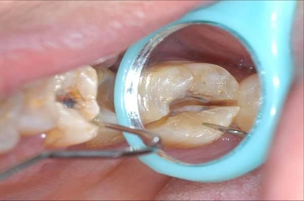 根管治疗完成后牙医建议我做牙套,是为了多赚