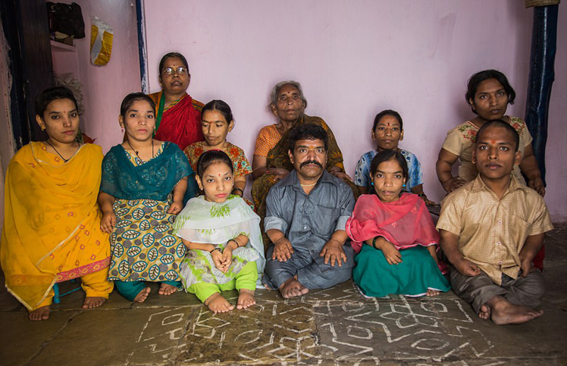 印度海得拉巴市一个家庭里的11名成员中有9个患有侏儒症。52岁的拉姆•拉杰•乔汉（Ram Raj Chauhan）是家里的大家长，他介绍说，每个成员都受一种叫软骨发育不全的遗传疾病的影响，这种疾病会导致侏儒症。难以置信的是，拉姆的家族曾经由21人组成，其中18人患有这种疾病。