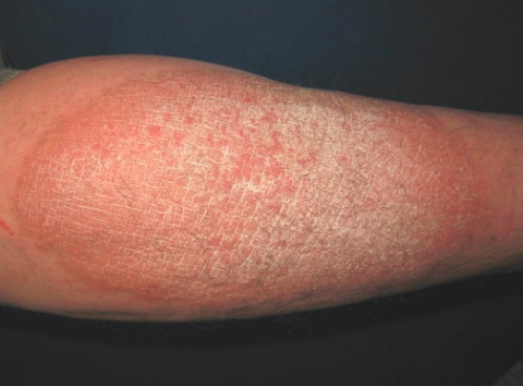 皮肤癣遗传吗?看这里就知道答案了