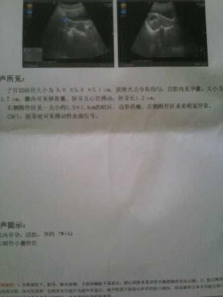 12年输卵管积液到盆腔积液、输卵管炎症伞端