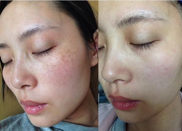 祛斑很简单,大妈巧用开塞露配上它,睡前一敷七