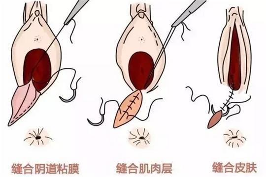 产道撕裂 顺产图片