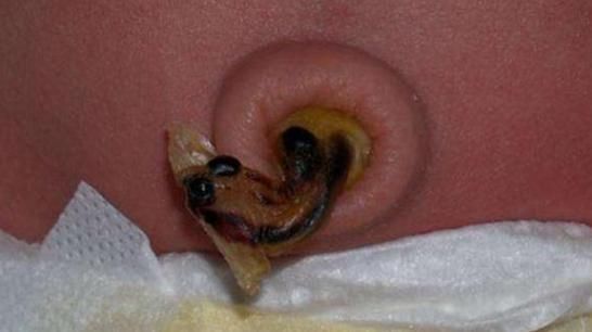 婴儿肚脐流脓血,医生告诉检查结果,老公怒提离