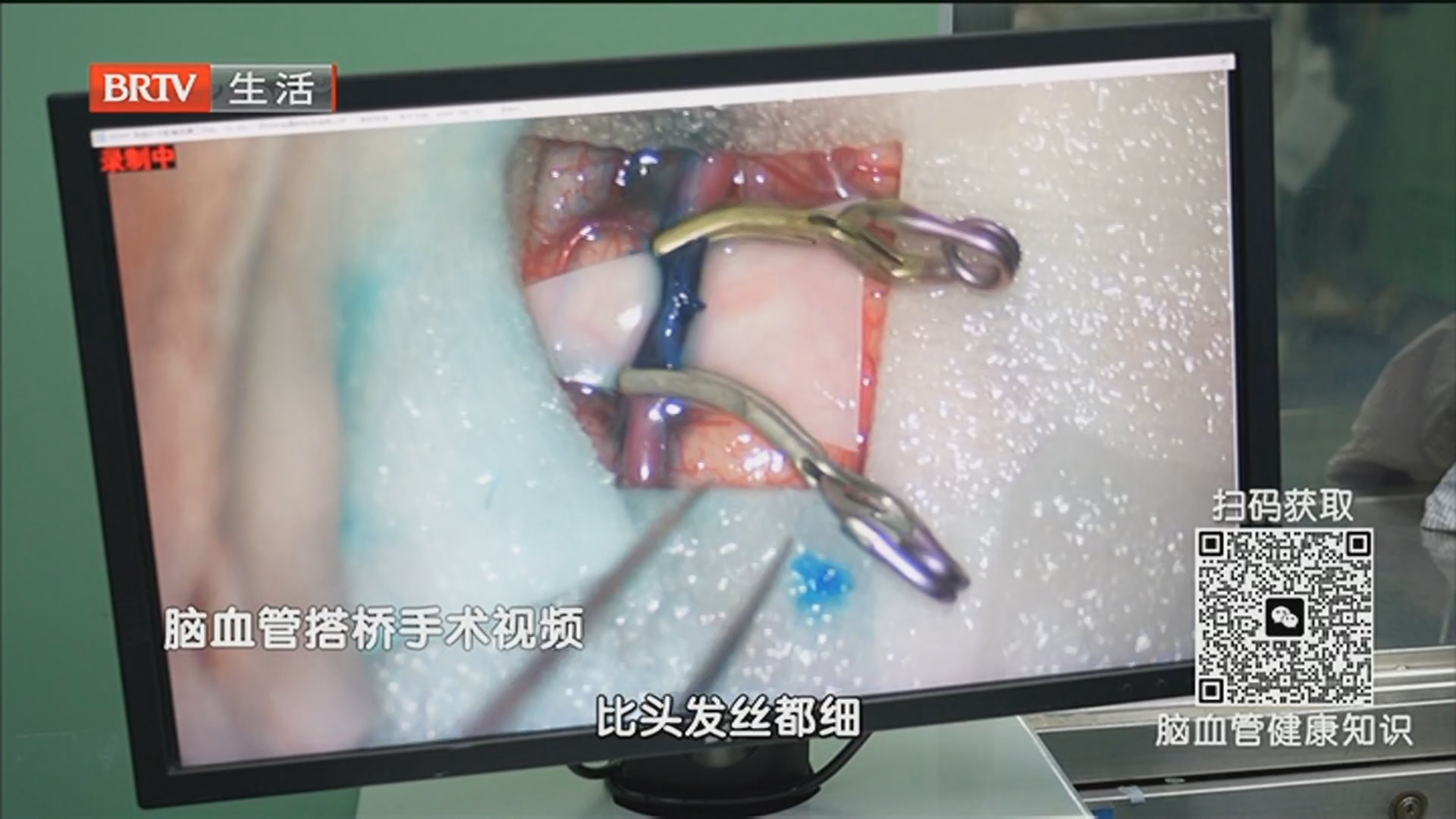 《全民健康学院》20260330警惕隐藏在“脑梗”下的烟雾病