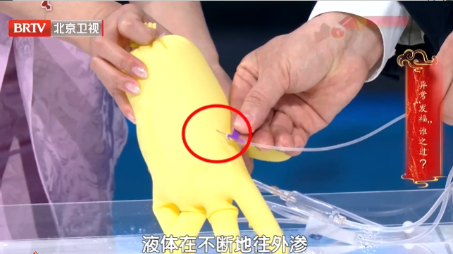 蛋白尿既是糖肾的临床表现,也是损伤肾脏的“毒药” 蛋白尿既是糖肾的临床表现,也是损伤肾脏的“毒药”