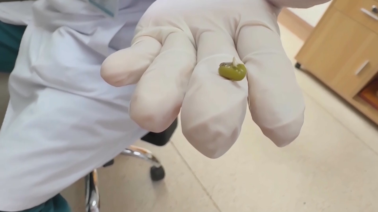 一岁宝宝鼻塞流涕 竟是鼻孔藏豆芽 一岁宝宝鼻塞流涕 竟是鼻孔藏豆芽