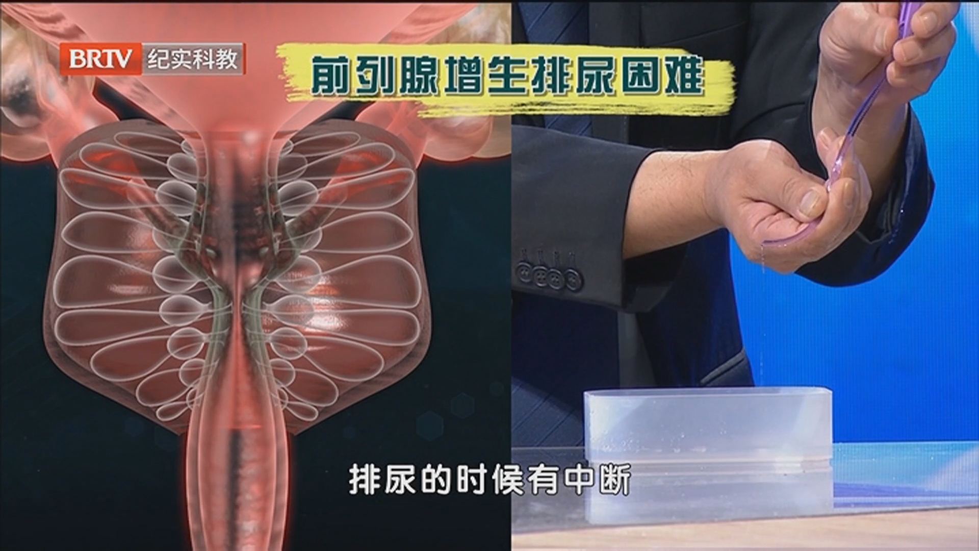 《职场健康说》20260608健康防线:破解前列腺迷局 《职场健康说》20260608健康防线:破解前列腺迷局