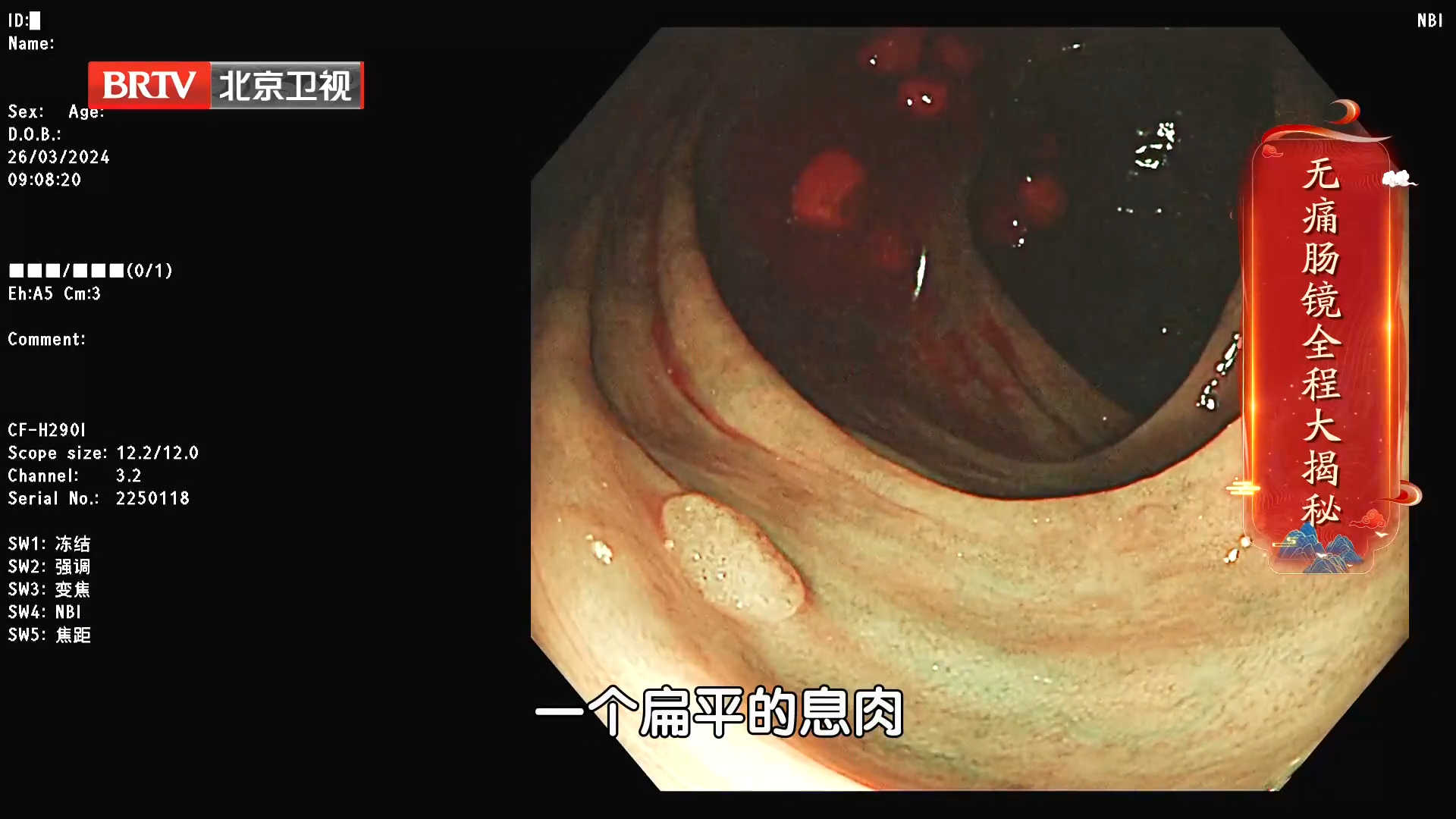 无痛肠镜怎么做?专家教你四句口诀,让肠道准备得更干净~ 无痛肠镜怎么做?专家教你四句口诀,让肠道准备得更干净~