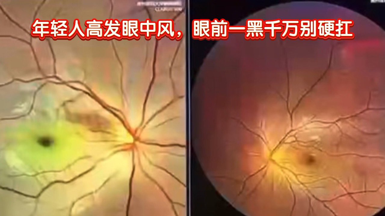 年轻人高发眼中风!眼前一黑千万别硬扛 年轻人高发眼中风!眼前一黑千万别硬扛