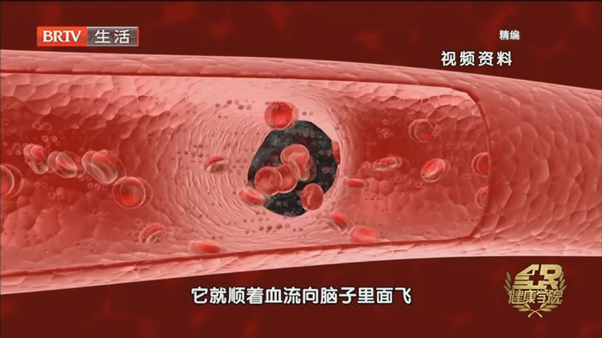 《全民健康学院》20260609打通血管通路 中西医共治斑块