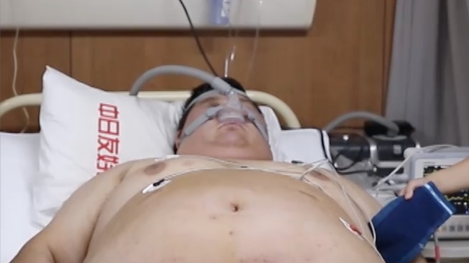 减重之路仍有荆棘，术后险情藏着无尽担忧