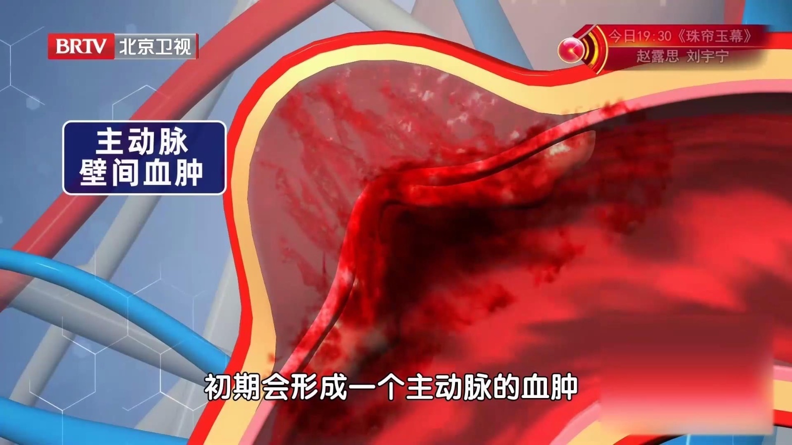 主动脉溃疡发生壁间血肿，最终会引起主动脉夹层