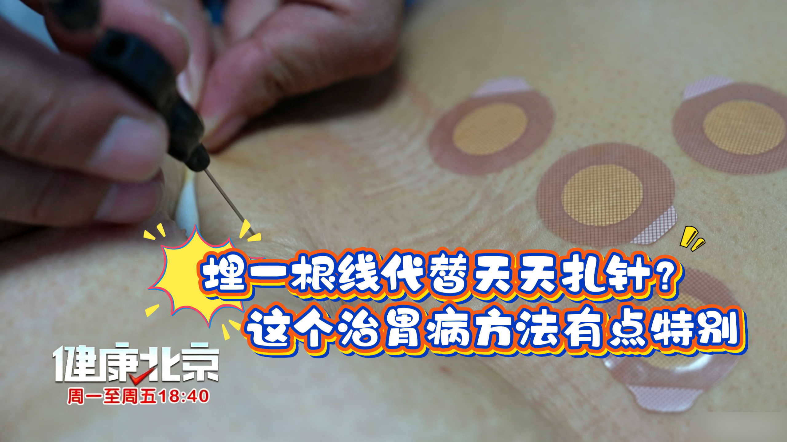 埋一根线代替天天扎针?这个治胃病方法有点特别 埋一根线代替天天扎针?这个治胃病方法有点特别