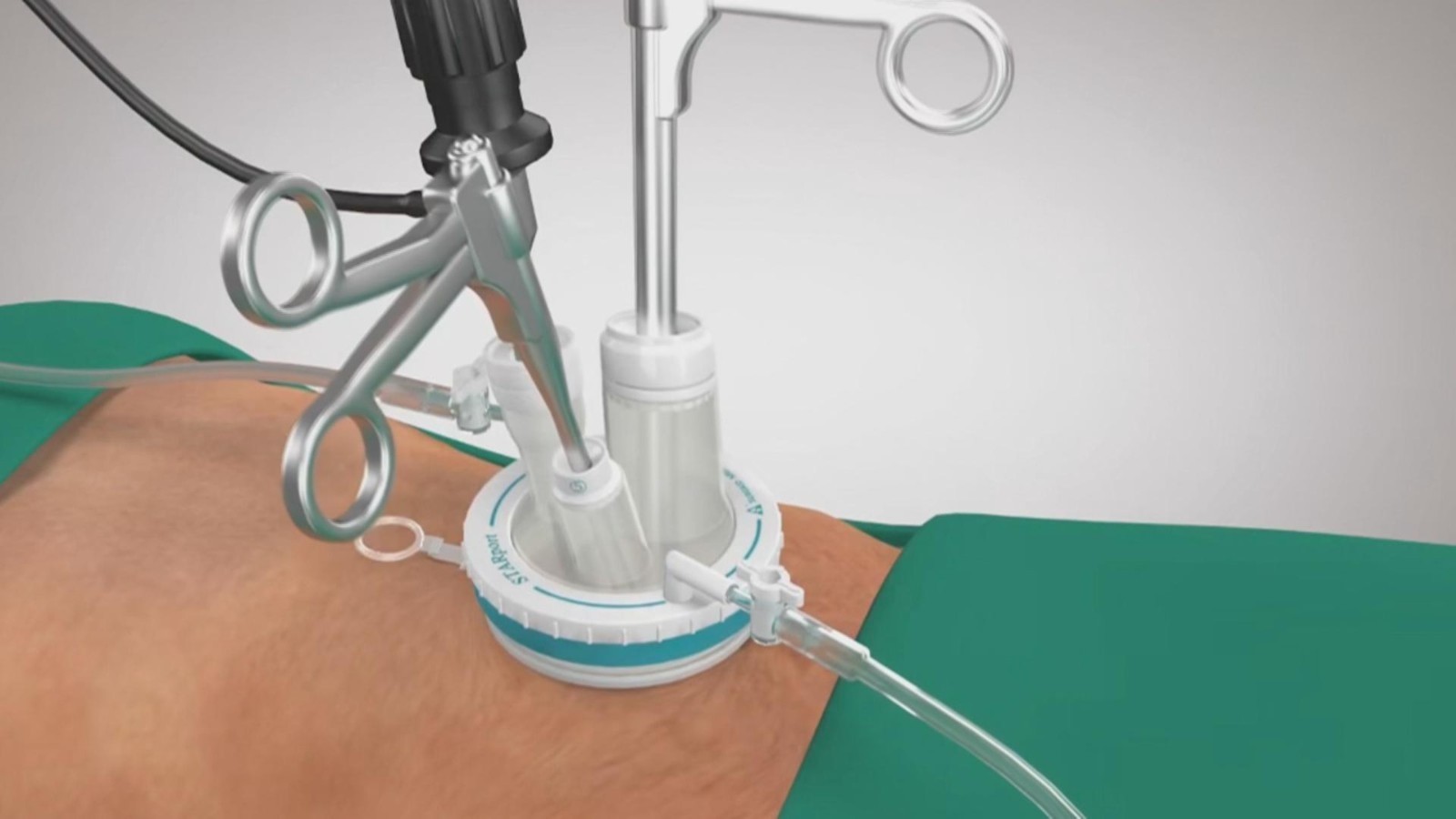 连续腹泻两个月查出恶性肠肿瘤 新技术只用小切口完成大手术