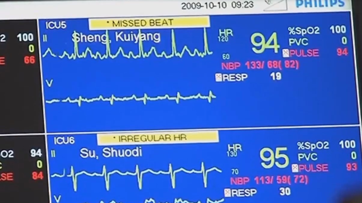 全球最小心脏泵 救了六旬心梗老人一命